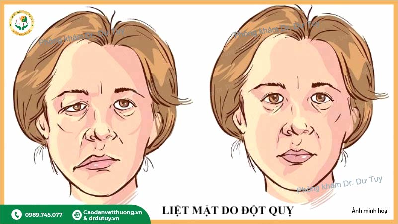 liệt mặt do đột quỵ