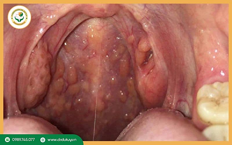 Lở loét amidan là gì? Có nguy hiểm không?