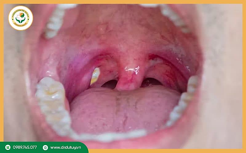 Lở loét amidan là gì? 