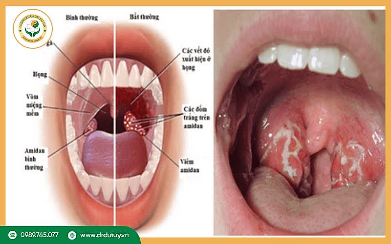 Triệu chứng viêm amidan