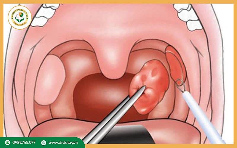 Phương pháp điều trị amidan