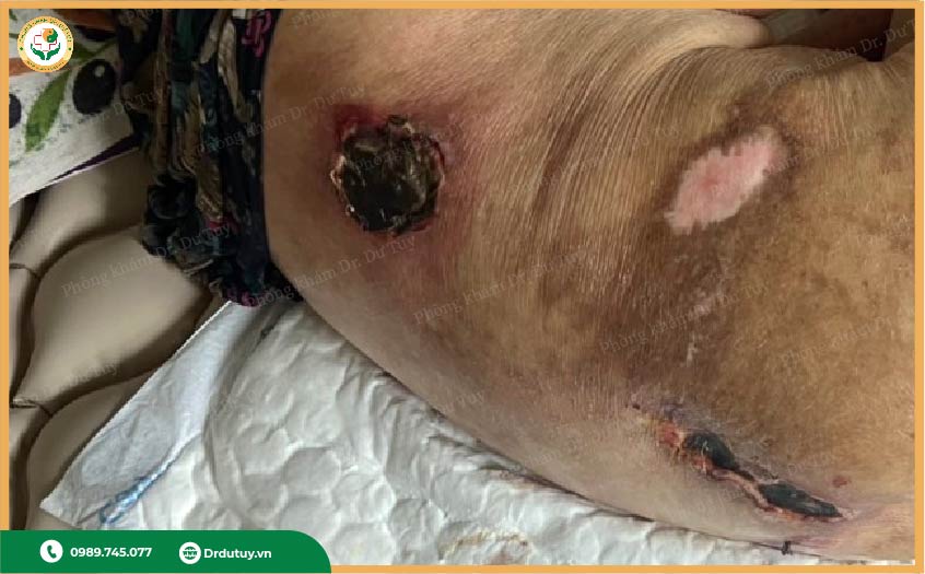 lở loét có nguy hiểm không?