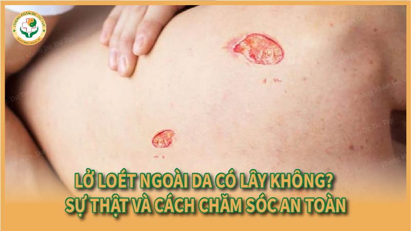 Lở loét ngoài da có lây không? Sự thật và cách chăm sóc an toàn