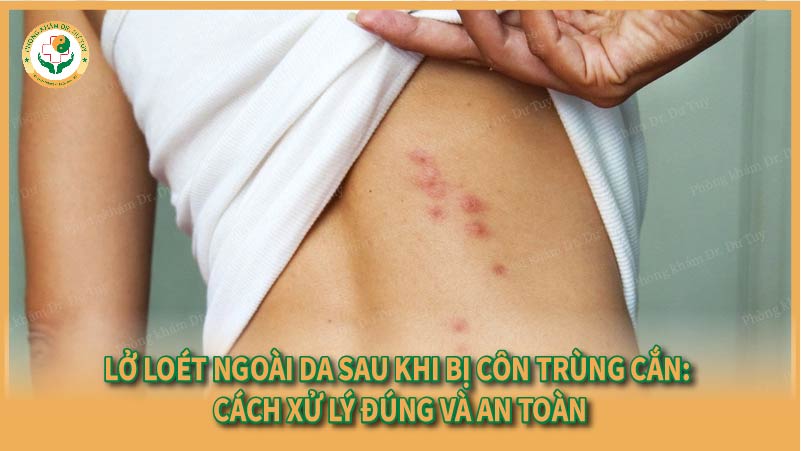 Lở loét ngoài da sau khi bị côn trùng cắn: Cách xử lý đúng và an toàn