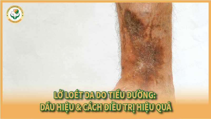 Lở loét da do tiểu đường: Dấu hiệu & cách điều trị hiệu quả