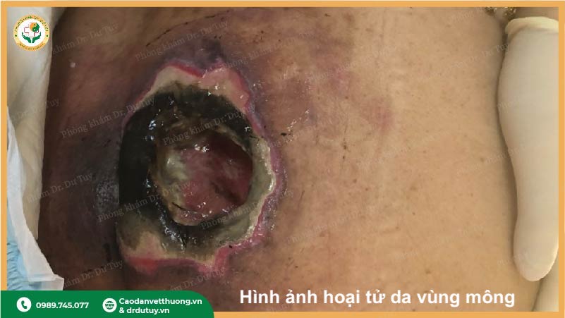 lở loét da gây hoại tử