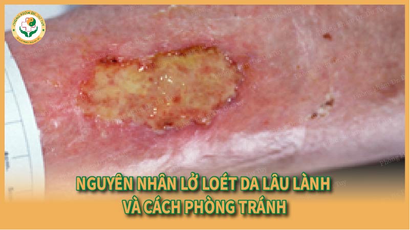 Nguyên nhân lở loét da lâu lành và cách phòng tránh