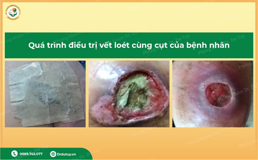 lở loét da vùng cùng cụt ở người cao tuổi