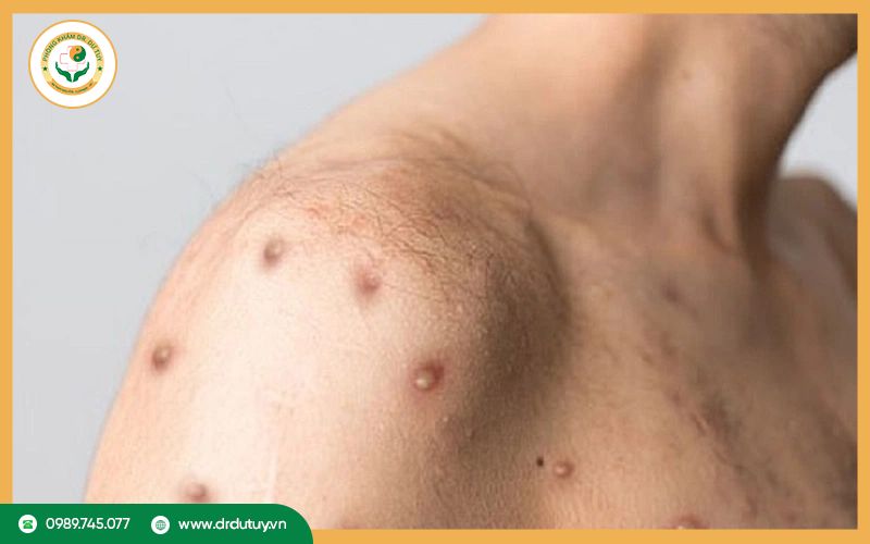 Vì sao bệnh nhân HIV bị lở loét?