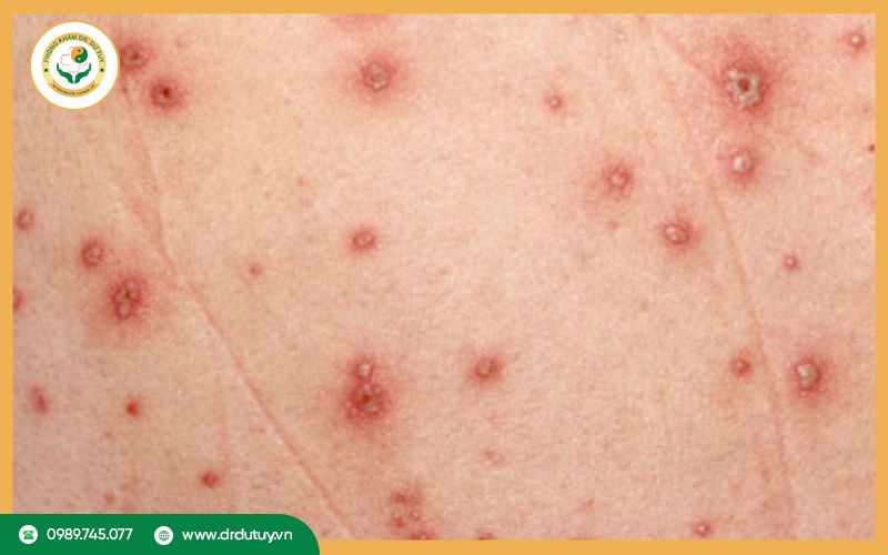 Các vị trí lở loét thường gặp khi nhiễm HIV