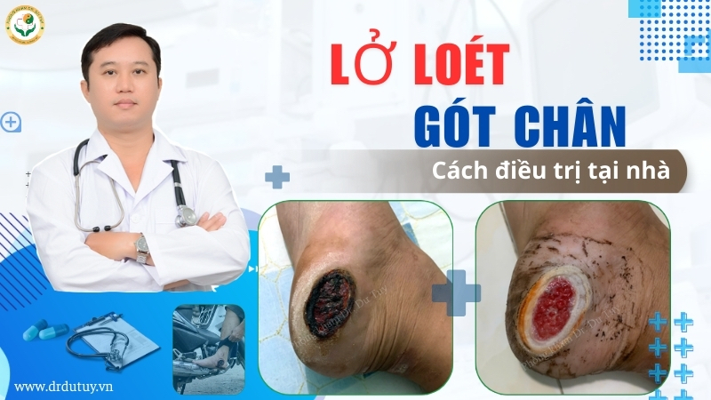 lở loét gót chân cách điều trị tại nhà