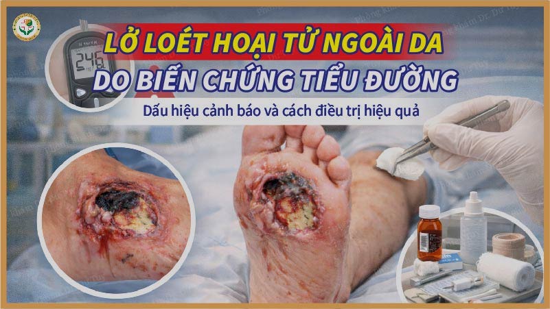 lở loét hoại tử ngoài da do biến chứng tiểu đường