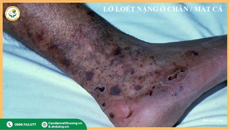 lở loét hoại tử ngoài da ở người cao tuổi