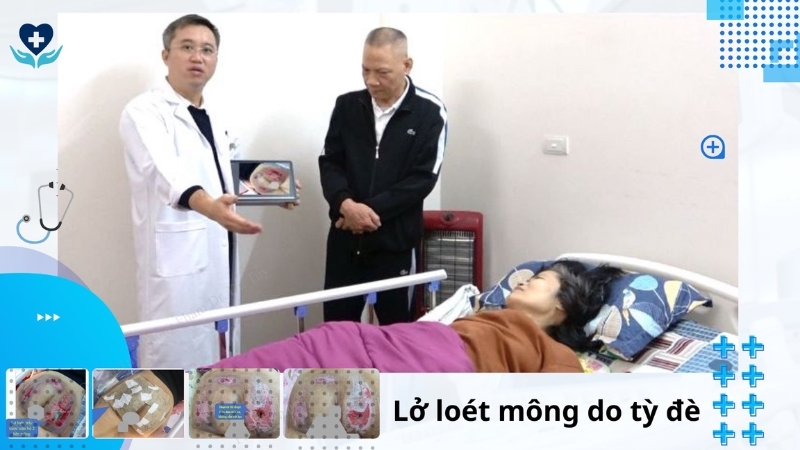 lở loét mông do tỳ đè bác sĩ dư tuy