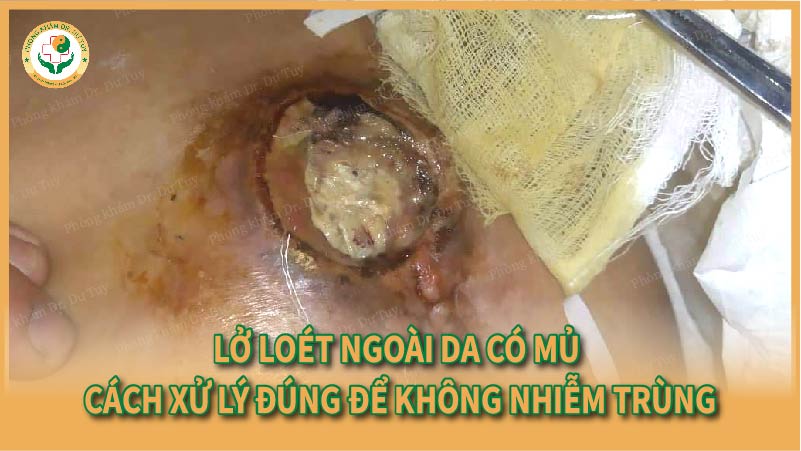 Lở loét ngoài da có mủ – Cách xử lý đúng để không nhiễm trùng