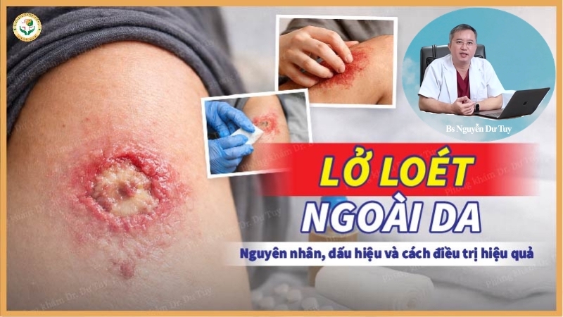 Lở loét ngoài da: Nguyên nhân, dấu hiệu và cách điều trị hiệu quả