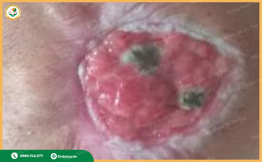 lở loét vùng cùng cụt