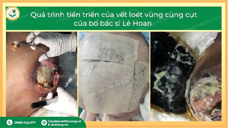 lở loét vùng cùng cụt người cao tuổi
