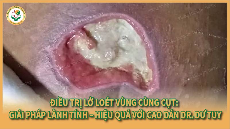 Điều trị lở loét vùng cùng cụt: Giải pháp lành tính – hiệu quả với Cao dán Dr. Dư Tuy