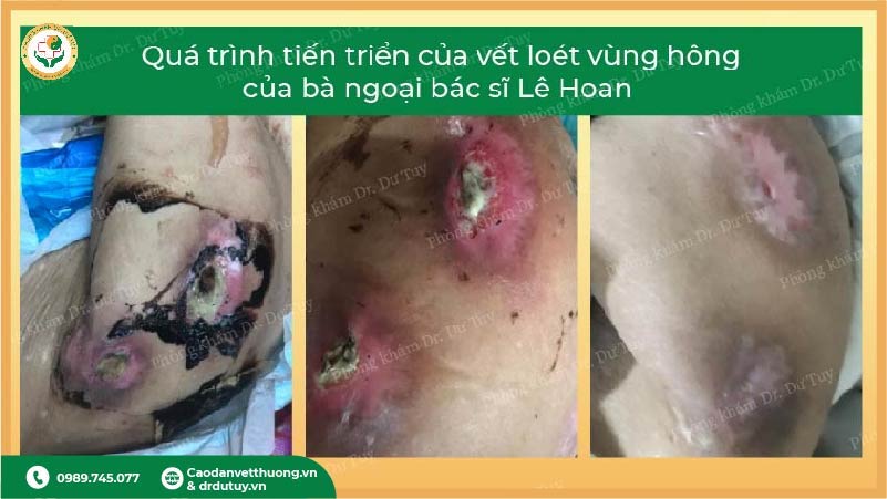 lở loét vùng hông người cao tuổi giai đoạn đầu