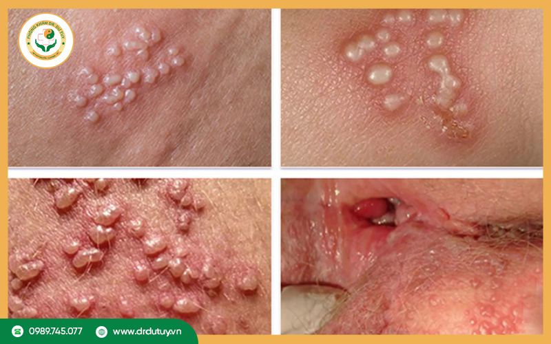 Herpes sinh dục
