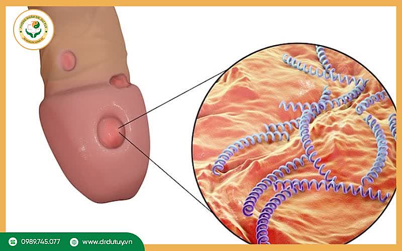 Lở loét vùng kín nam là gì?