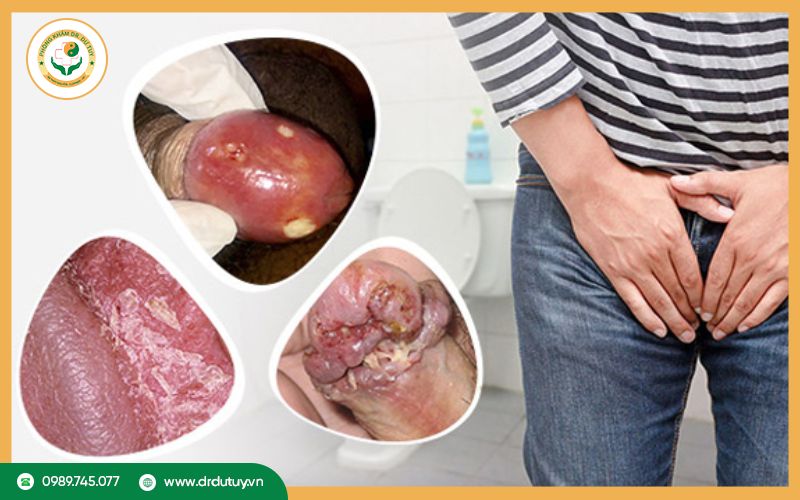 Nguyên nhân gây lở loét vùng kín nam