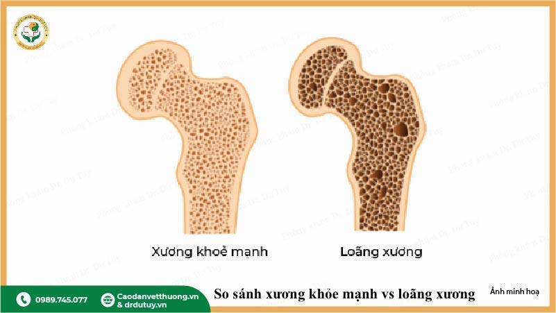 loãng xương do suy giảm estrogen phụ nữ