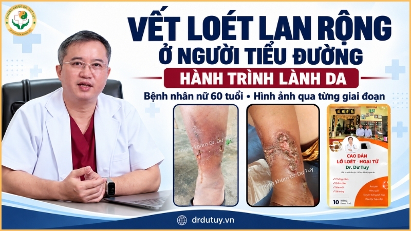 Loét cẳng chân ở người tiểu đường: Hành trình cùng Cao dán Dr. Dư Tuy