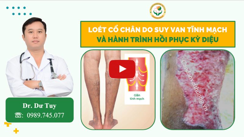 loét cổ chân