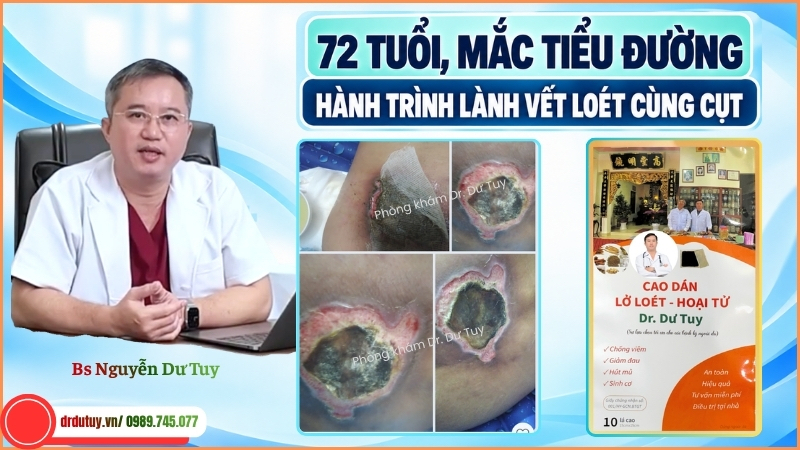 loét cùng cụt bệnh nhân 72 tuổi tiểu đường