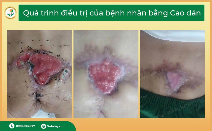 loét cùng cụt do nằm lâu