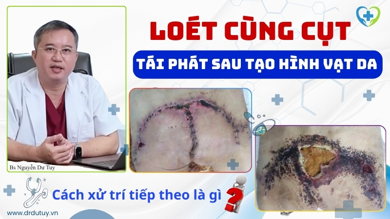 loét cùng cụt tái phát sau tạo hình vạt da