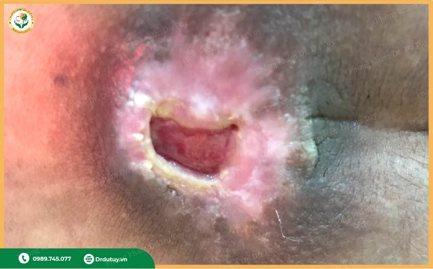 loét da do nằm lâu