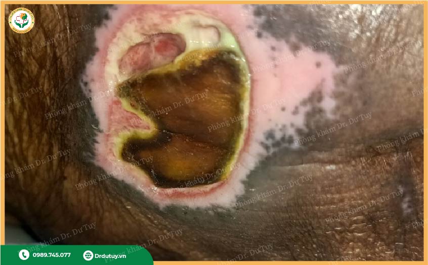 loét da do tiểu đường