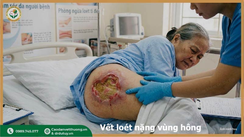 loét da nặng ở người nằm lâu
