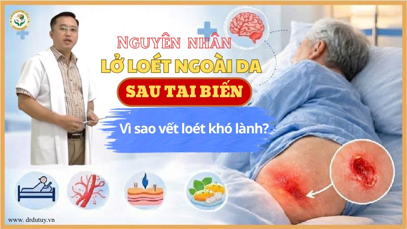 Nguyên nhân lở loét ngoài da sau tai biến – Vì sao vết loét khó lành?