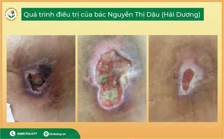 loét da vùng cùng cụt