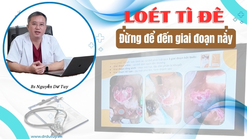 Lở loét da vùng cùng cụt- Biến chứng nguy hiểm ở người già nằm lâu
