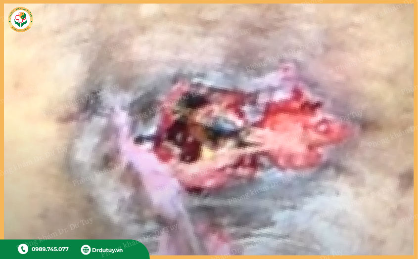 loét da vùng cùng cụt