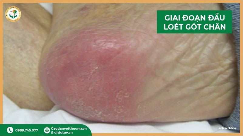 loét gót chân giai đoạn đầu
