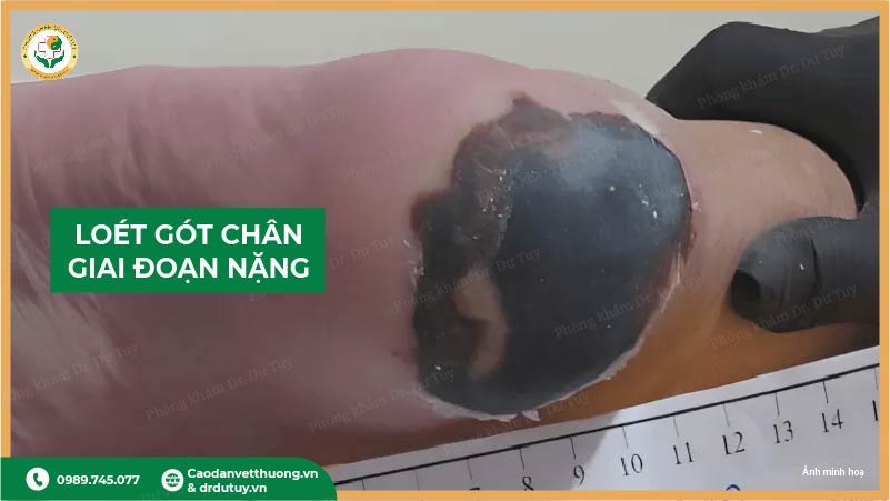 loét gót chân giai đoạn nặng