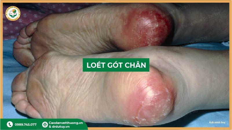 loét gót chân giai đoạn nhẹ