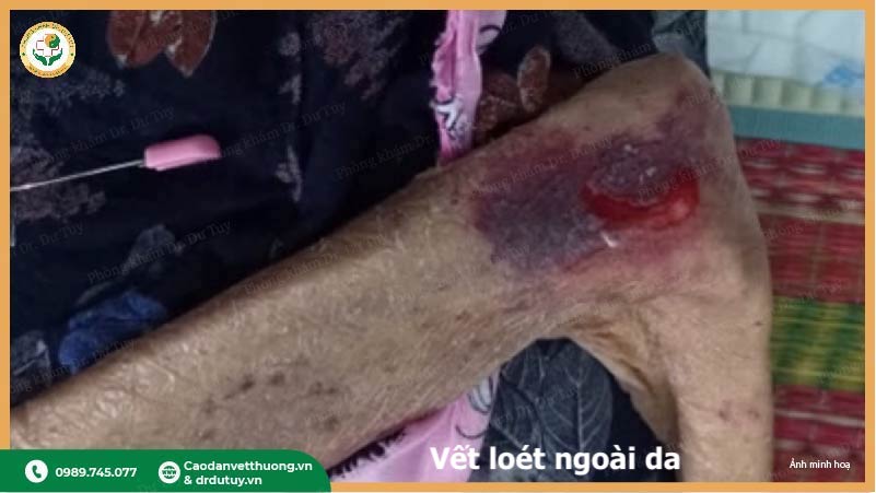 loét gót chân ở người nằm lâu