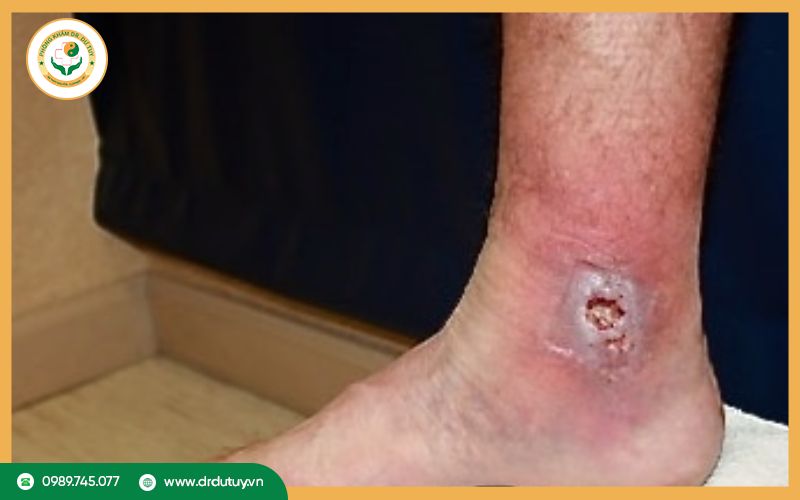 Dấu hiệu nhận biết loét tỳ đè độ 2