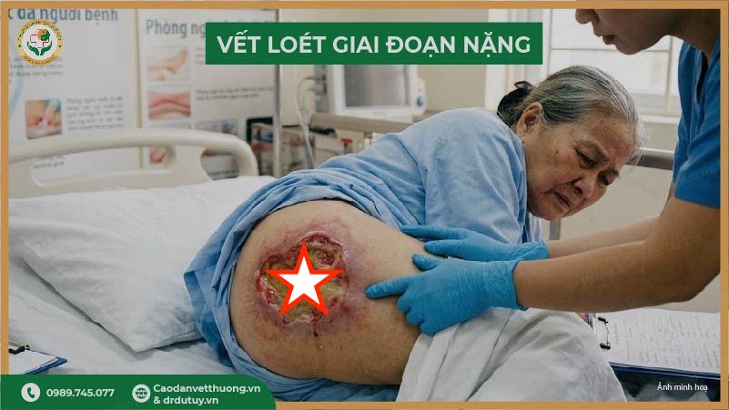loét tì đè giai đoạn nặng