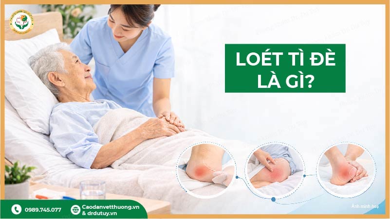 loét tì đè là gì ở người nằm lâu