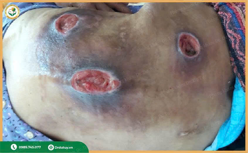 loét tì đè lưng