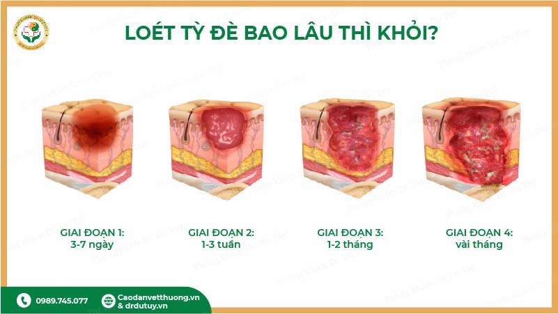 loét tỳ đè bao lâu thì khỏi theo từng giai đoạn