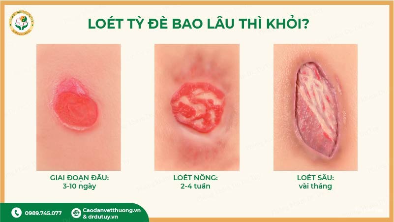 loét tỳ đè bao lâu thì khỏi